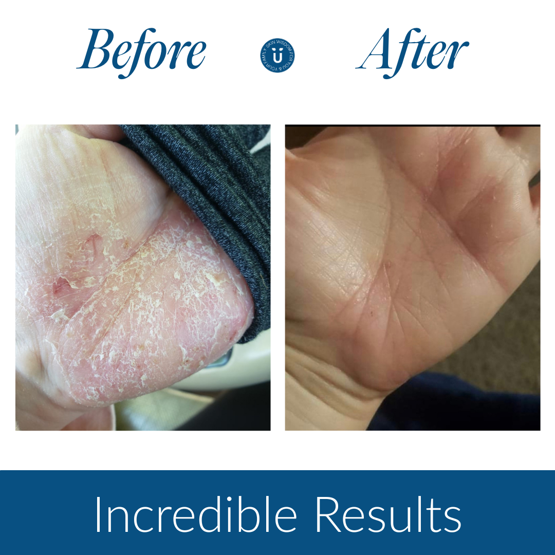Clear Your Eczema & Psoriasis—Solid Face & Body Balm